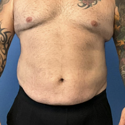 Abdominoplasty | Before Male Tummy Tuck
